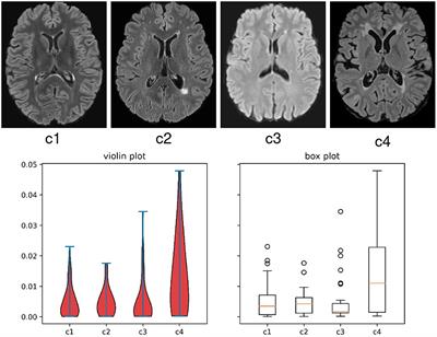 Multiple sclerosis lesion segmentation: revisiting weighting mechanisms for federated learning